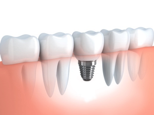 Dr. Wegdell Hamburg Kurzimplantat