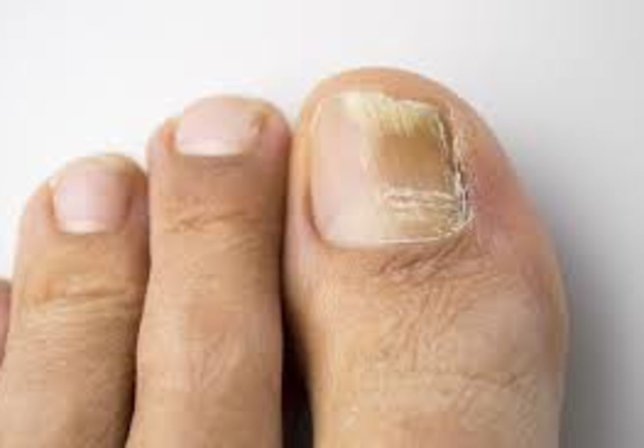Fungal Nail Infections